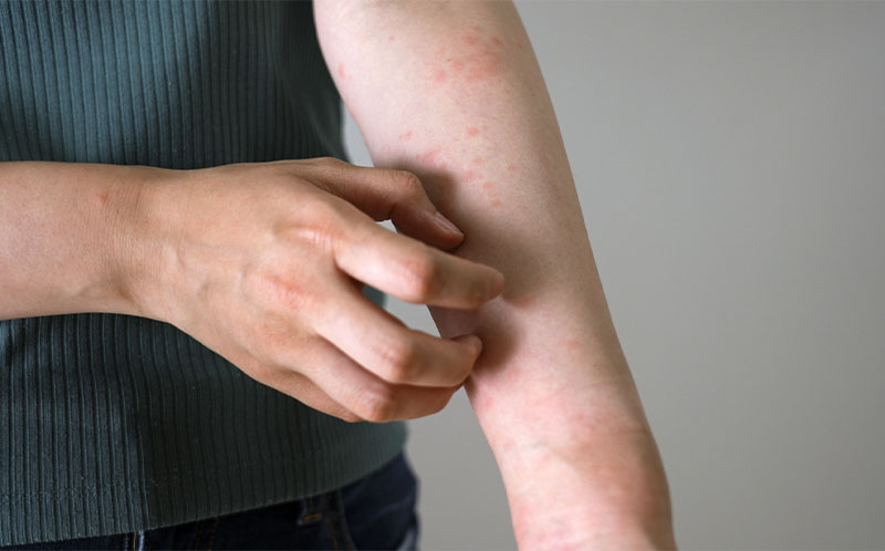 全身性エリテマトーデス（SLE）と妊娠